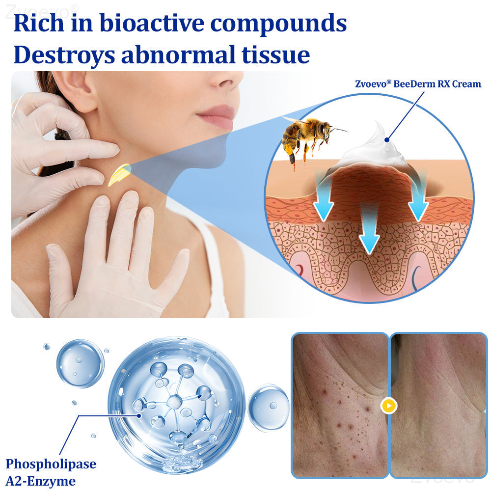🔥 Zvoevo® BeeDerm RX Cream | Gentle Targeted Care for Warts, Skin Tags, Bumps, Infections, Cysts and Scars