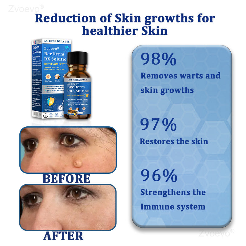 💝Zvoevo® BeeDerm RX Solution | Gentle, Targeted Care for Warts, Skin Tags, Skin Lesions, Infections, Cysts and Scars