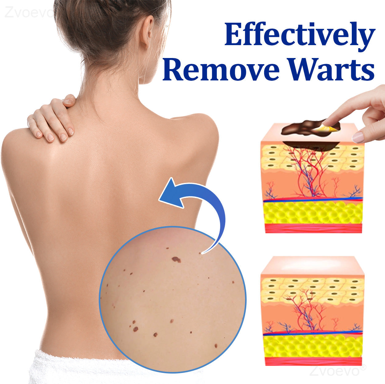 💝Zvoevo® BeeDerm RX Solution | Gentle, Targeted Care for Warts, Skin Tags, Skin Lesions, Infections, Cysts and Scars