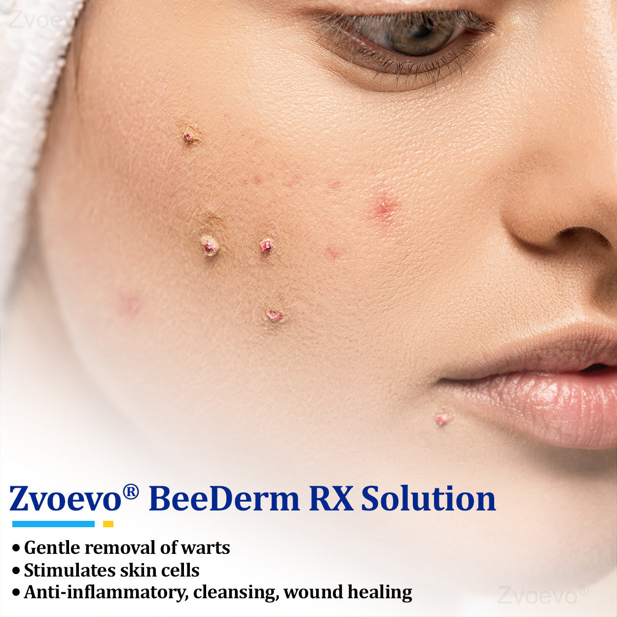 💝Zvoevo® BeeDerm RX Solution | Gentle, Targeted Care for Warts, Skin Tags, Skin Lesions, Infections, Cysts and Scars
