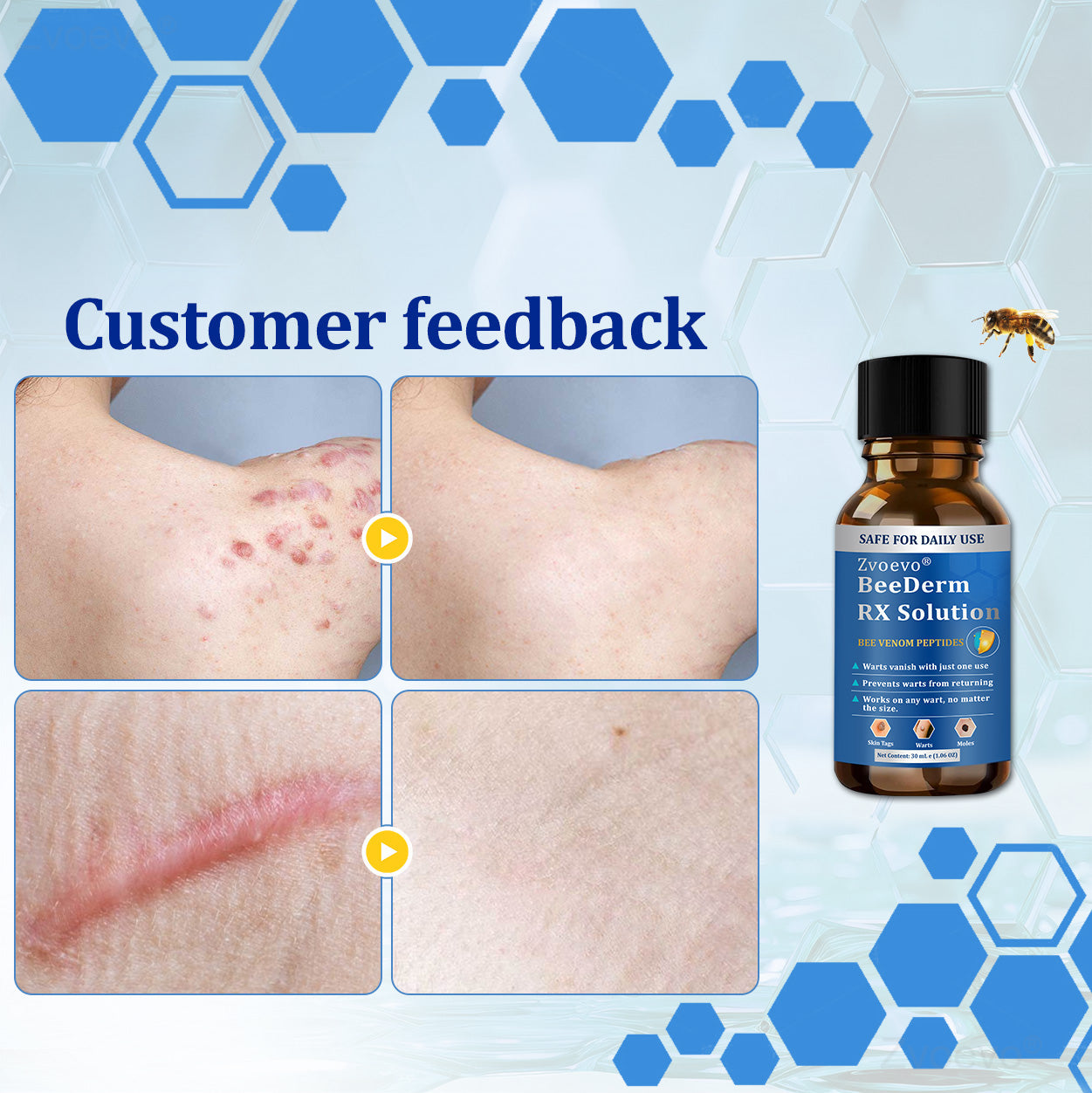 💝Zvoevo® BeeDerm RX Solution | Gentle, Targeted Care for Warts, Skin Tags, Skin Lesions, Infections, Cysts and Scars