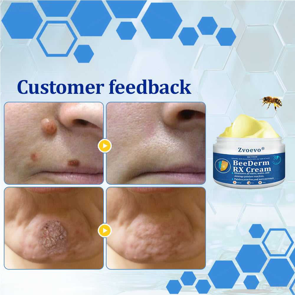 🔥 Zvoevo® BeeDerm RX Cream | Gentle Targeted Care for Warts, Skin Tags, Bumps, Infections, Cysts and Scars