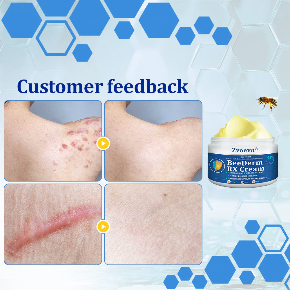 🔥 Zvoevo® BeeDerm RX Cream | Gentle Targeted Care for Warts, Skin Tags, Bumps, Infections, Cysts and Scars