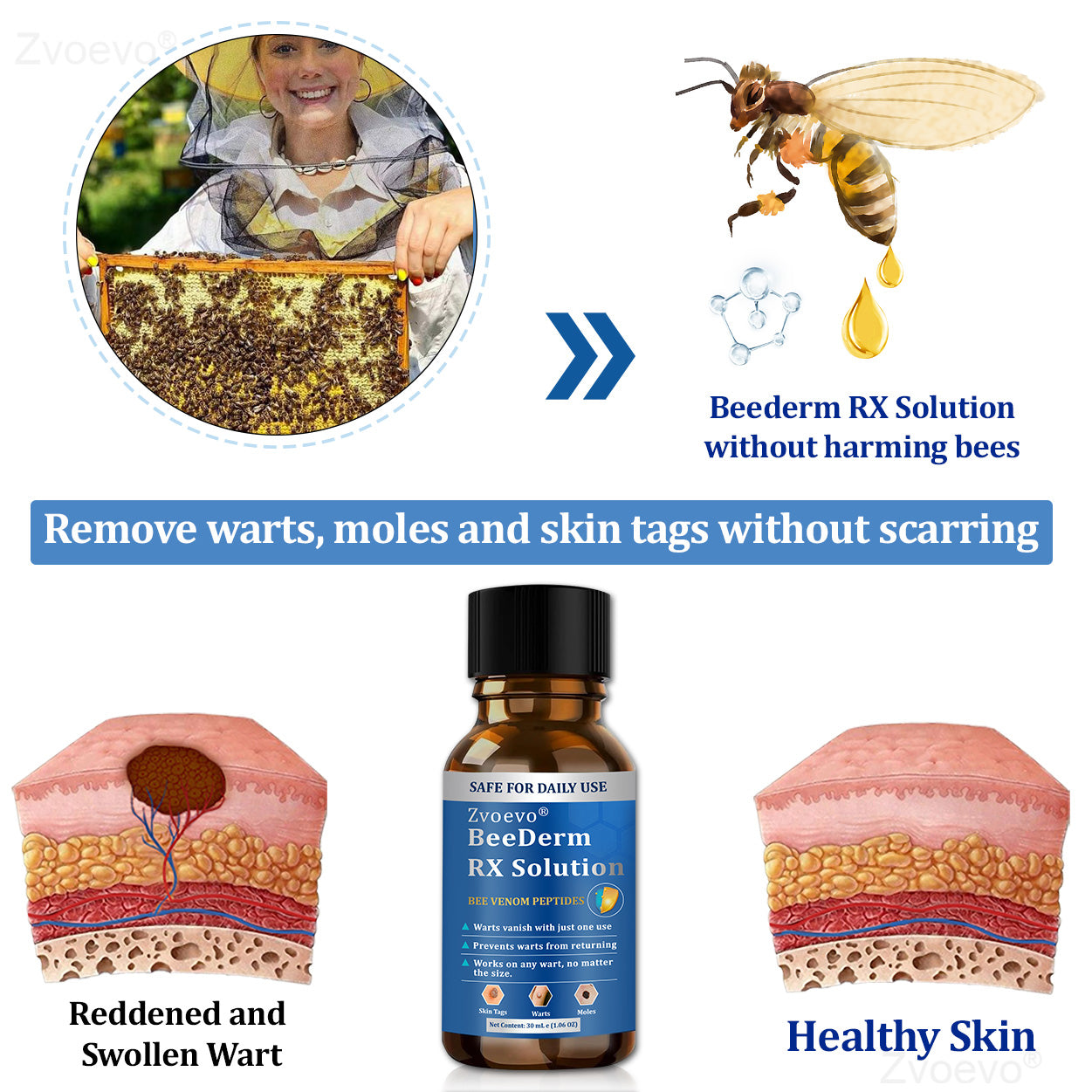 💝Zvoevo® BeeDerm RX Solution | Gentle, Targeted Care for Warts, Skin Tags, Skin Lesions, Infections, Cysts and Scars