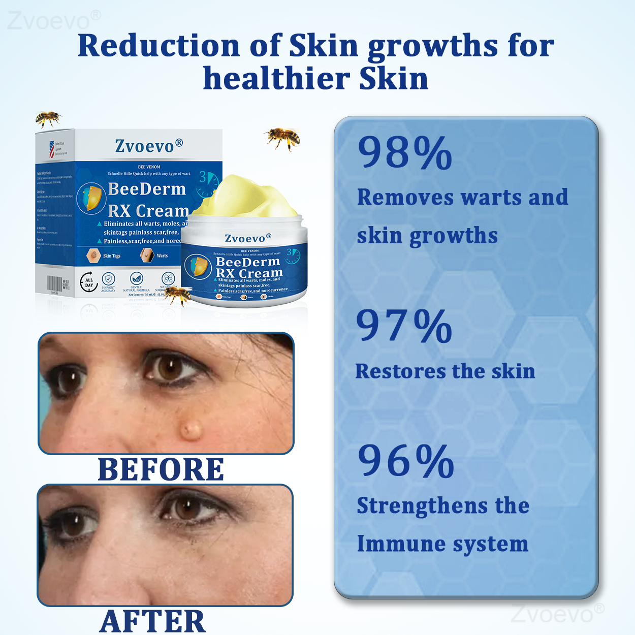 🔥 Zvoevo® BeeDerm RX Cream | Gentle Targeted Care for Warts, Skin Tags, Bumps, Infections, Cysts and Scars
