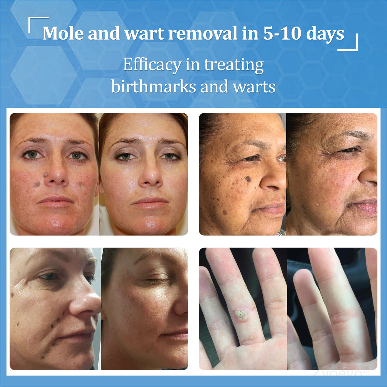 💝Zvoevo® BeeDerm RX Solution | Gentle, Targeted Care for Warts, Skin Tags, Skin Lesions, Infections, Cysts and Scars