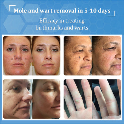 💝Zvoevo® BeeDerm RX Solution | Gentle, Targeted Care for Warts, Skin Tags, Skin Lesions, Infections, Cysts and Scars
